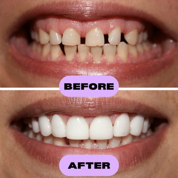 Flex-Smile Silicone Veneers